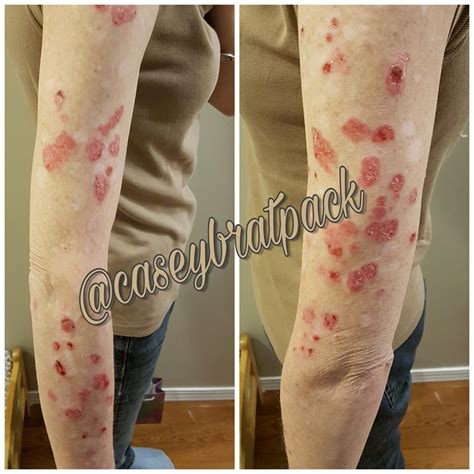 Autoimmune Skin Rashes On Legs