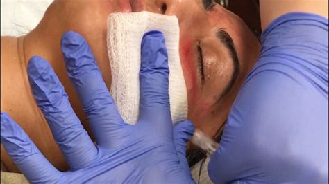 eclipse prp treatment youtube