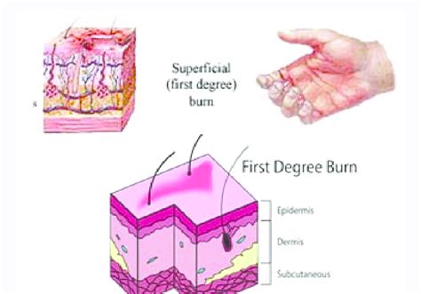 First degree burns are the least severe. First Degree of Burn. | Download Scientific Diagram