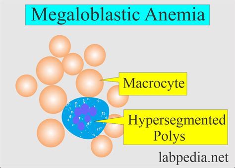 Anemia Part 3 Megaloblastic Anemia Macrocytic Vitamin B12 And
