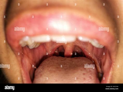 Tonsils High Resolution Stock Photography And Images Alamy