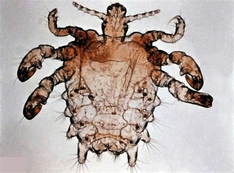 Pubic Lice Or Crab Lice Signs Symptoms Transmission And Pubic Lice