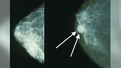 Fda Updates Regulations For Mammograms And Breast Density Checks Wny