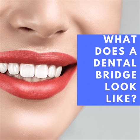 What Does A Dental Bridge Look Like Mccartney Dental North Port Fl