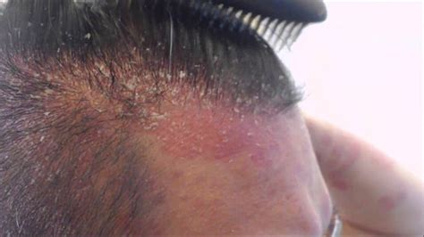 Dermatite Seborroica Capelli E Cuoio Capelluto Rimedi Cause E La Cura