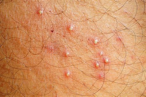Folliculitis Symptoms Causes And Treatment By Beautifullike Aug