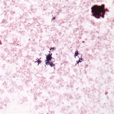 Gram Stain Performed On Blood Cultures Showing Branching Gram Positive