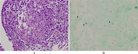 A Case Series Of Histoplasmosis Patients With Elevated Serum Soluble