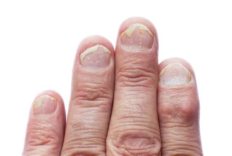 8 Effects Of Psoriatic Arthritis On The Body Medical News Today