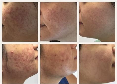 Perma saç öncesi ve sonrası. DERMAPEN