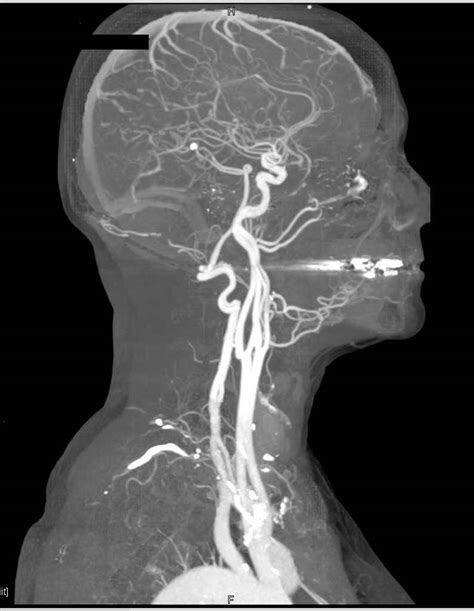If an abnormal sound, called a bruit, is heard over an artery, it may reflect. CTA with DE of Carotid Arteries - Neuro Case Studies - CTisus CT Scanning