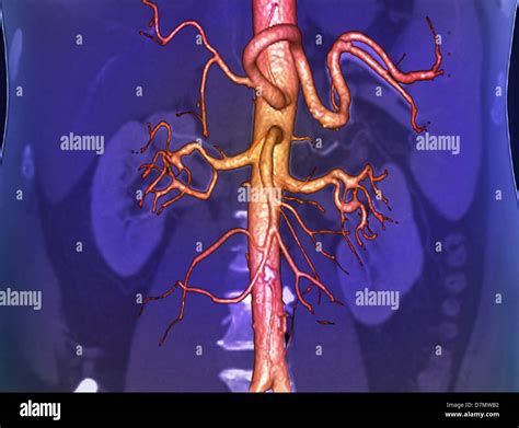 Abdominal Aorta 3d Ct Scan Stock Photo 56392646 Alamy