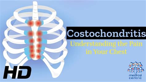 Costochondritis Breaking Free From The Grip Of Chest Discomfort YouTube