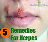 Holistic Cure For Genital Herpes Images