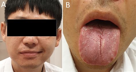 Recurrent Facial Palsy And Fissured Tongue European Journal Of