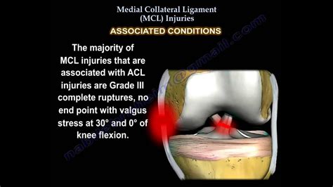 Medial Collateral Ligament Injury Mcl Injuries Everything You Need