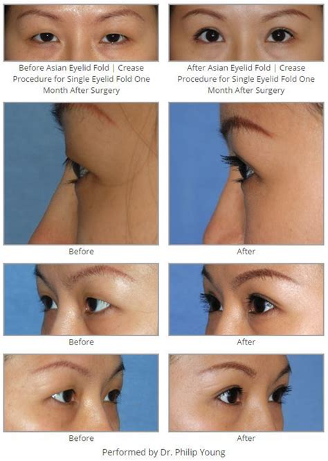 Before After Asian Eyelid Fold Crease Procedure For Single Eyelid
