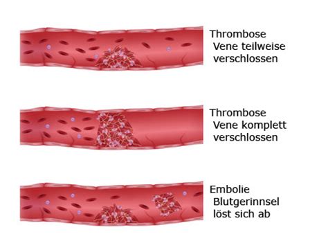 On distingue deux types de thrombose la thrombose artérielle obstruant une artère, qui se révèle plus grave si l'artère en cause est la seule à irriguer une zone précise du corps. Embolie Et Thrombose; embolies et thromboses