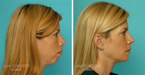 What Is Double Jaw Surgery Your Top Questions Answered Jaw Surgery La