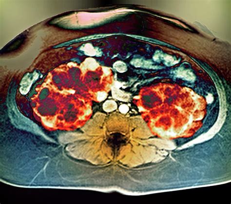 Polycystic Kidneys 2 Photograph By Zephyrscience Photo Library Pixels