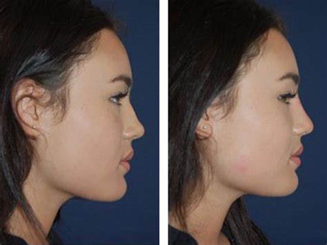 That's because there is none. Non Surgical Nose Job (Rhinoplasty) Costs in London - 111 ...