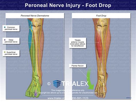 Peroneal Nerve Injury Foot Drop Trial Exhibits Inc