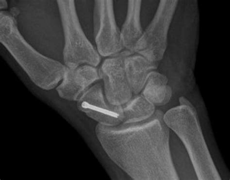 Trauma Wrist Carpal Fractures And Dislocations Eg Scaphoid Dr