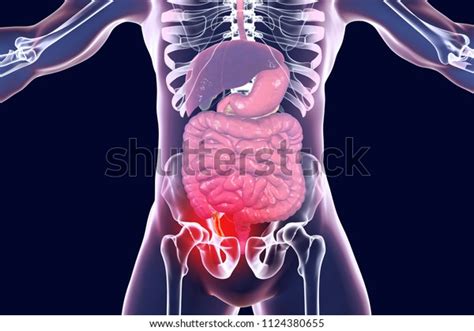 Acute Appendicitis 3d Illustration Showing Inflammed Appendix On The