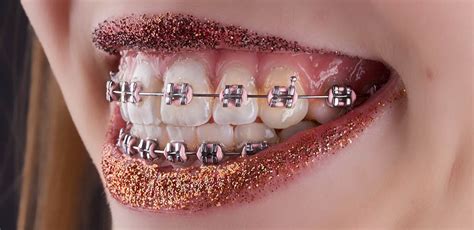 Cosmetic Braces Sparklysmile Dental Blackheath