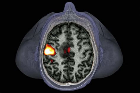 Thousands of fMRI brain studies in doubt due to software flaws | New 