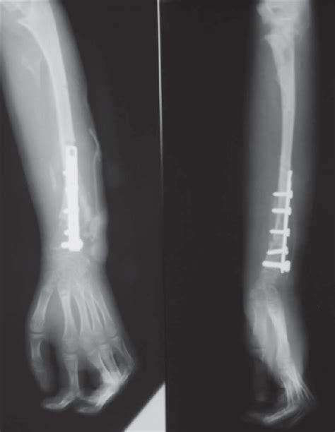 Osteosynthesis Between The Radius And Ulna Dorsiflexion Of The Wrist