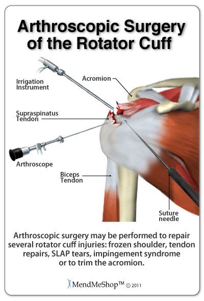Arthroscopic Rotator Cuff Repairs Are A Popular Way Of Treating Rotator