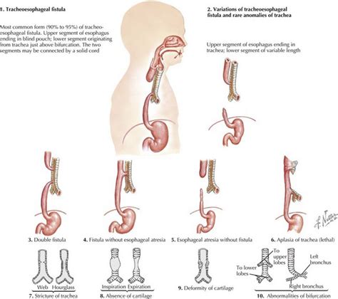 Disorders Of The Esophagus Obgyn Key