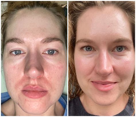 How To Use Tretinoin Properly Experience Using Tretinoin Correctly