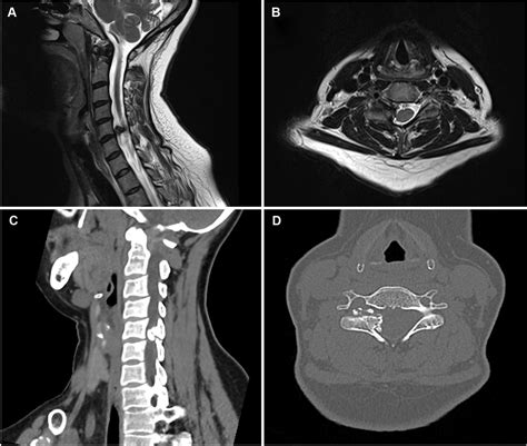 A Rare Case Of Cervical Facet Joint And Synovial Cyst At C5c6