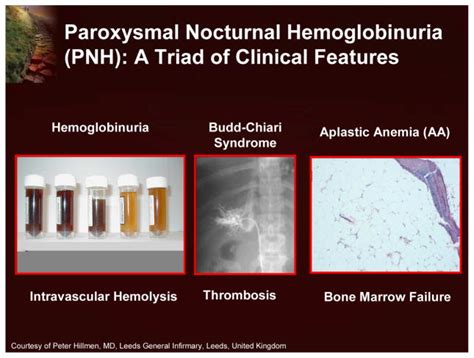 The Management Of Paroxysmal Nocturnal Hemoglobinuria Recent Advances