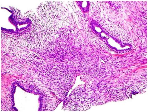 Significant Histologic Features Differentiating Cellular Fibroadenoma
