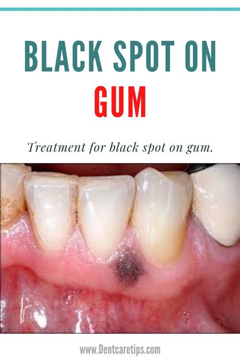 Causes Of Black Spot On Gum Gum Treatment Dental Laser Gum