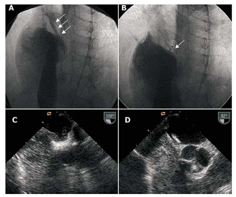 Percutaneous Closure Of Patent Foramen Ovale In Young Patients With