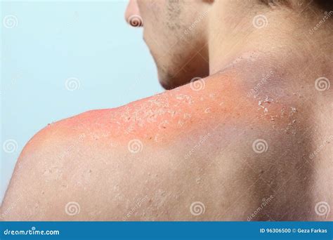 Man With Reddened Itchy Skin After Sunburn Cream On The Back Royalty