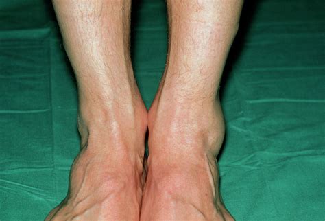View Of Swollen Left Ankle Due To Sprain Photograph By Dr P Marazzi Science Photo Library