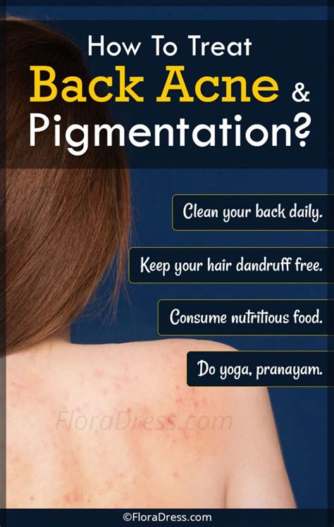 How To Treat Back Acne And Pigmentation Wellnesszing