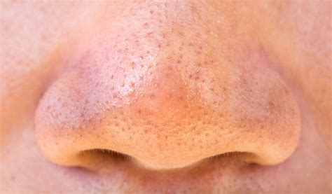 Pimples are annoying especially when they are painful. How To Get Rid of Pimples on the Nose (5 Easy Steps ...