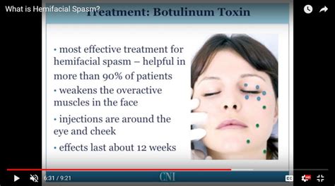 What Is Hemifacial Spasm Https Movementdisorderscenter Org