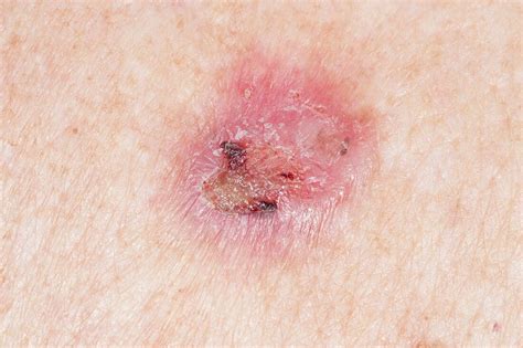 Basal Cell Skin Cancer On The Back Bild Kaufen 11627055 Science