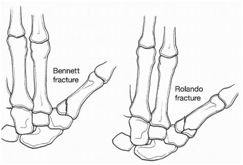 Base Of The Thumb Fractures Musculoskeletal Key