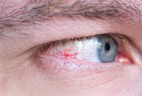 Premium Photo Close Up Of A Severe Bloodshot Red Eye Viral