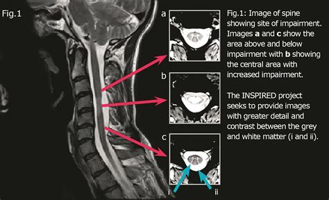 Inspired A Quantifiable Multi Centre Spinal Cord Neuro Imaging Project