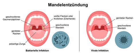 Mandelentzündung Schwabe Austria