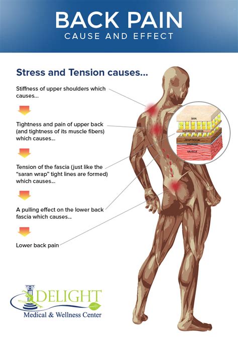 Myofascial Pain Syndrome Symptoms And Causes Mayo Clinic Pain Relief Program